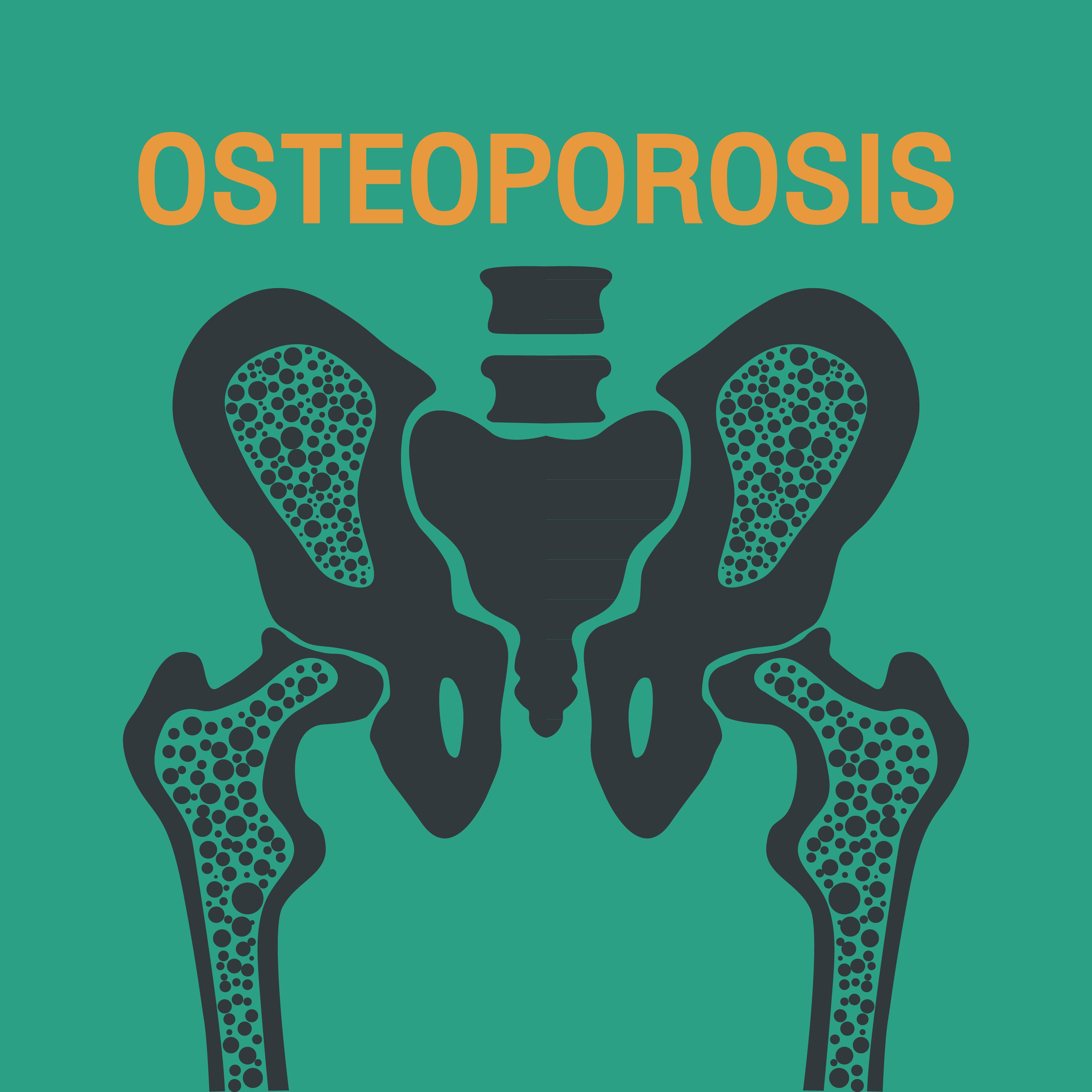 Little Workouts for Big Bones: Exercise for Osteoporosis Prevention
